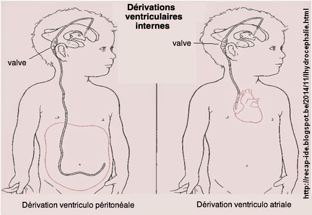 Ventriculo peritoneale ventriculo atriale