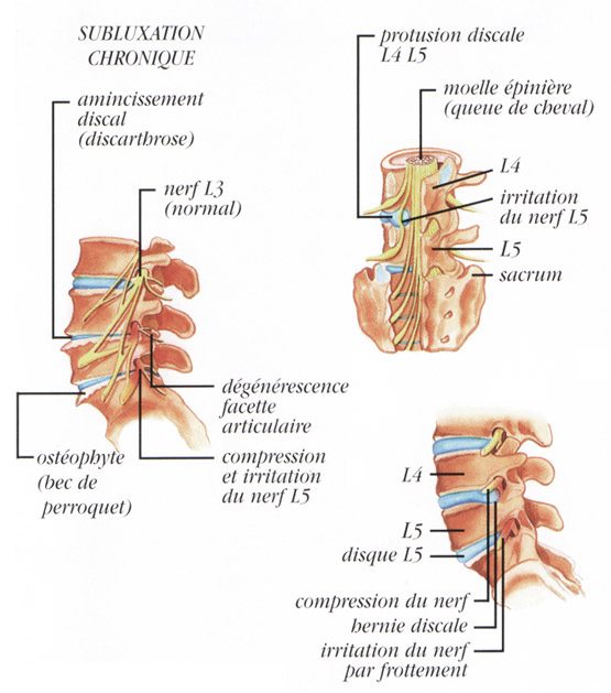 subluxation chronique